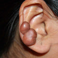Piercing Keloid