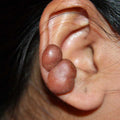 Piercing keloid