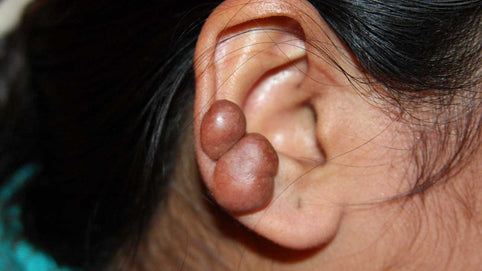 Piercing keloid