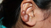 Piercing keloid