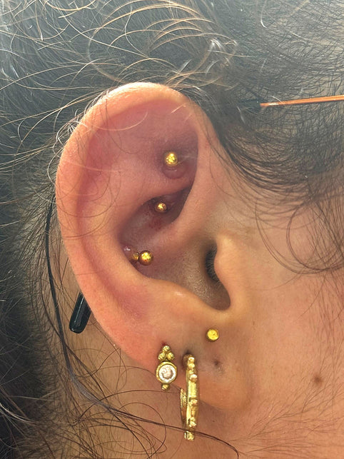 Voorbeeld van een piercing vochtbult bij kraakbeenpiercing